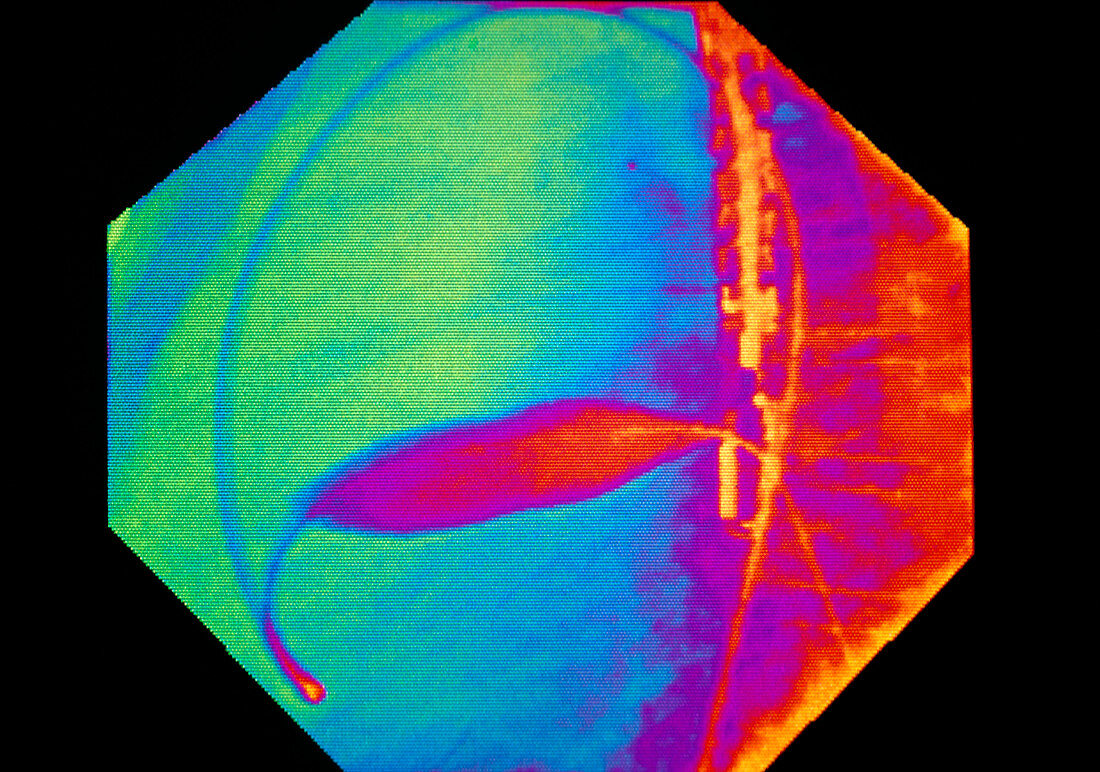 Coloured X-ray of cardiac angioplasty in progress