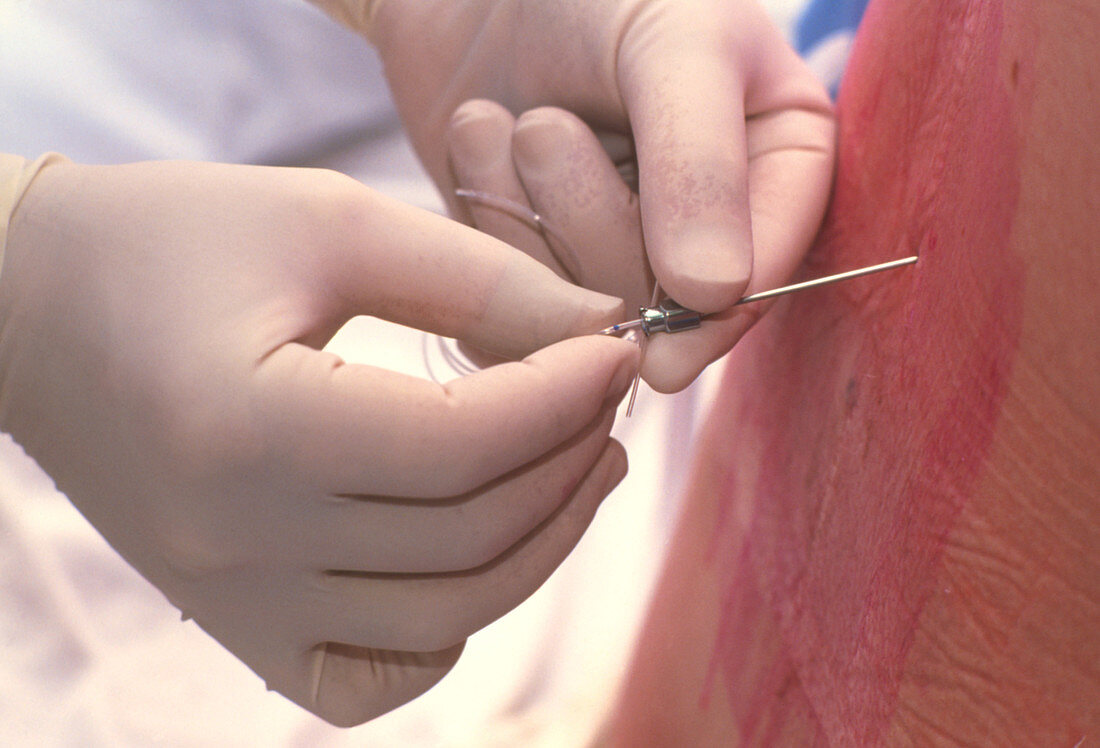 Doctor inserts catheter for epidural anaesthetic