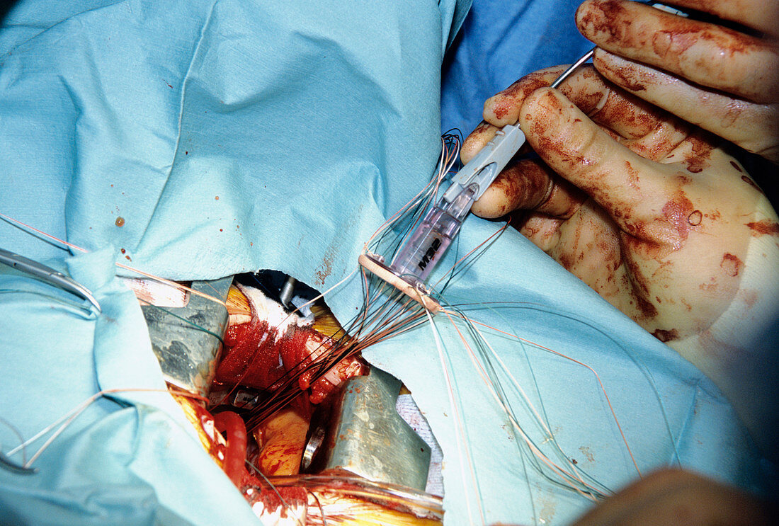 Artificial heart valve surgery