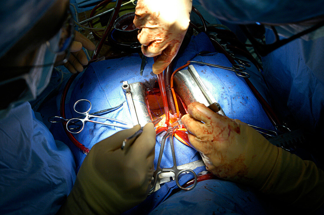 Heart valve surgery