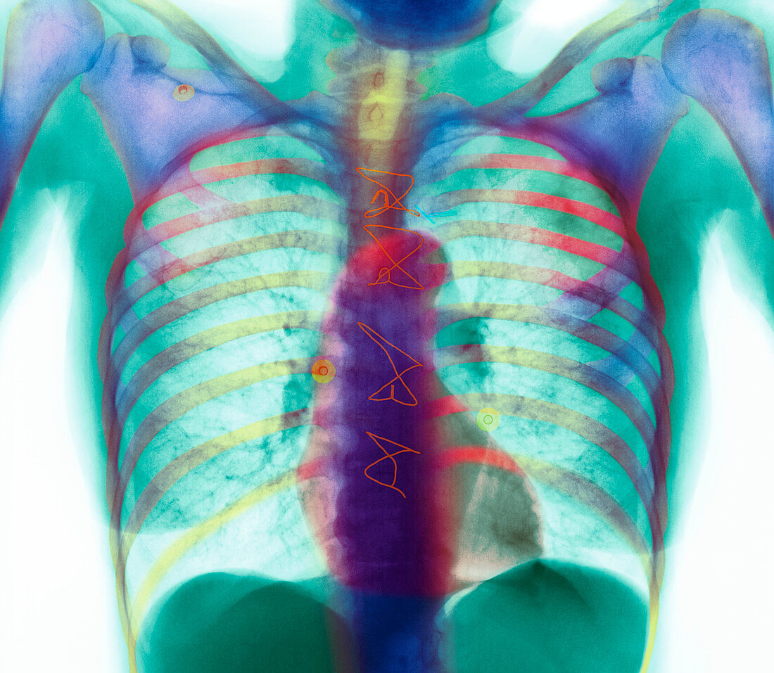 Heart after surgery,X-ray