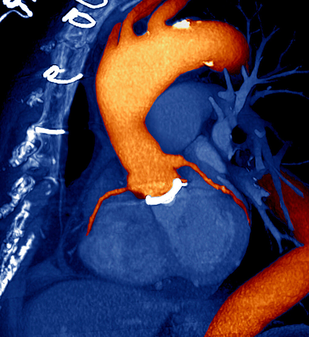 Prosthetic heart valve,3D CT scan