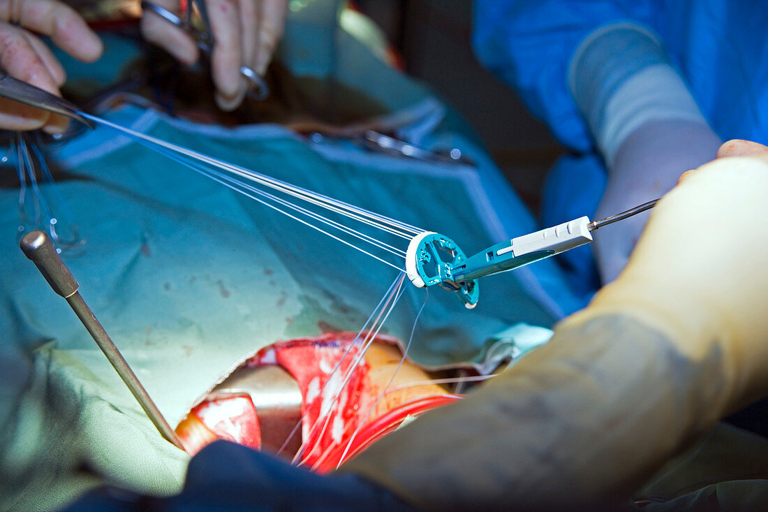 Heart valve repair surgery