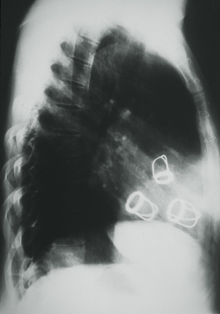 X-ray showing prosthetic heart valves in situ