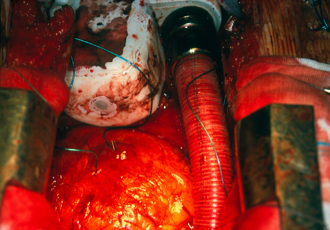 Heart implant seen joined to heart during surgery