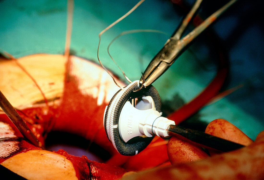 Heart valve surgery