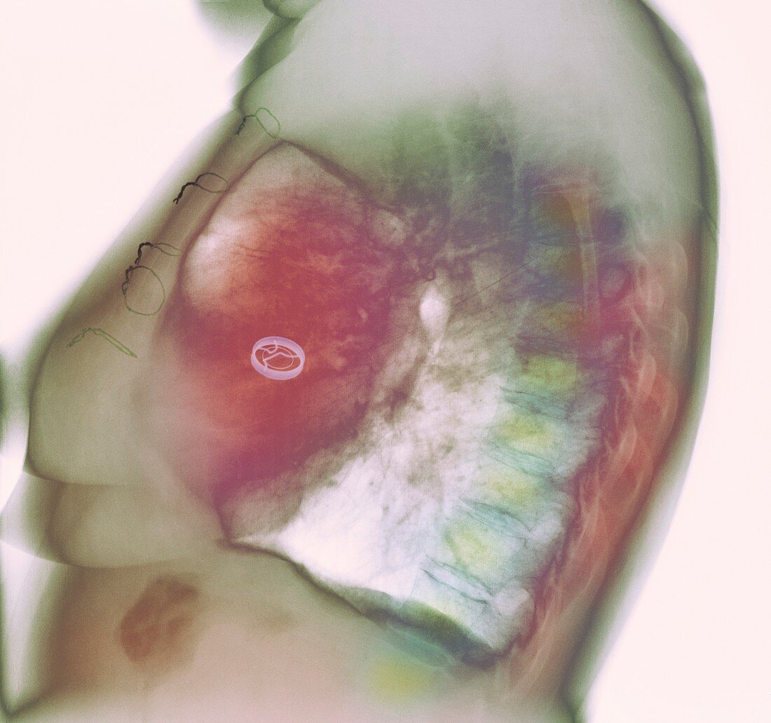 Heart valve replacement,X-ray