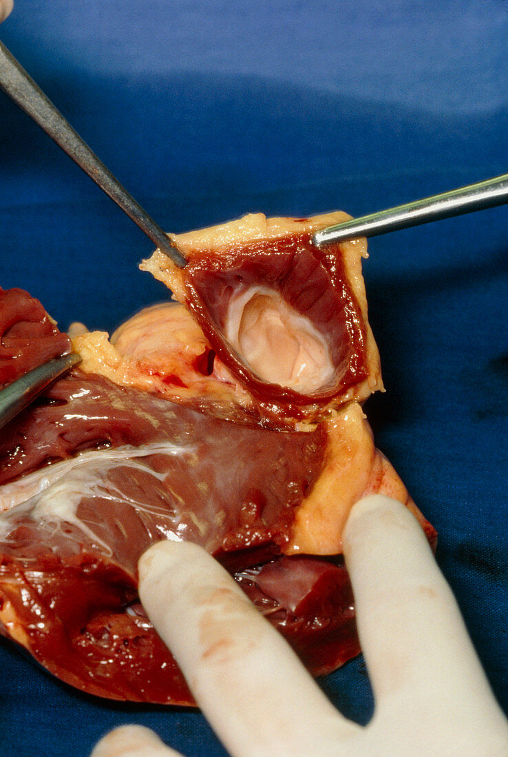 Dissection of aortic valve from donor human heart