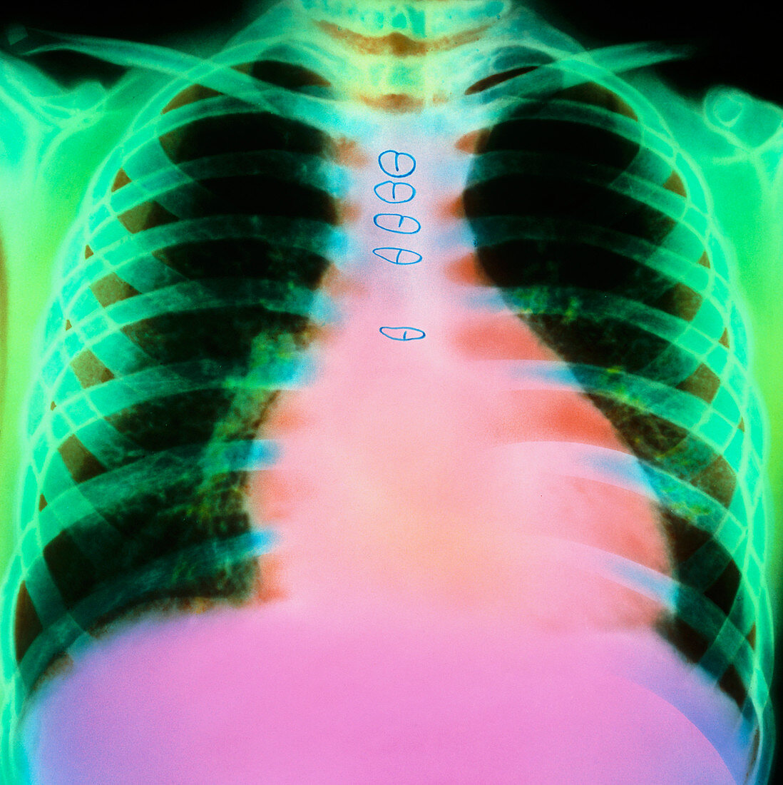 Transplanted heart,chest X-ray