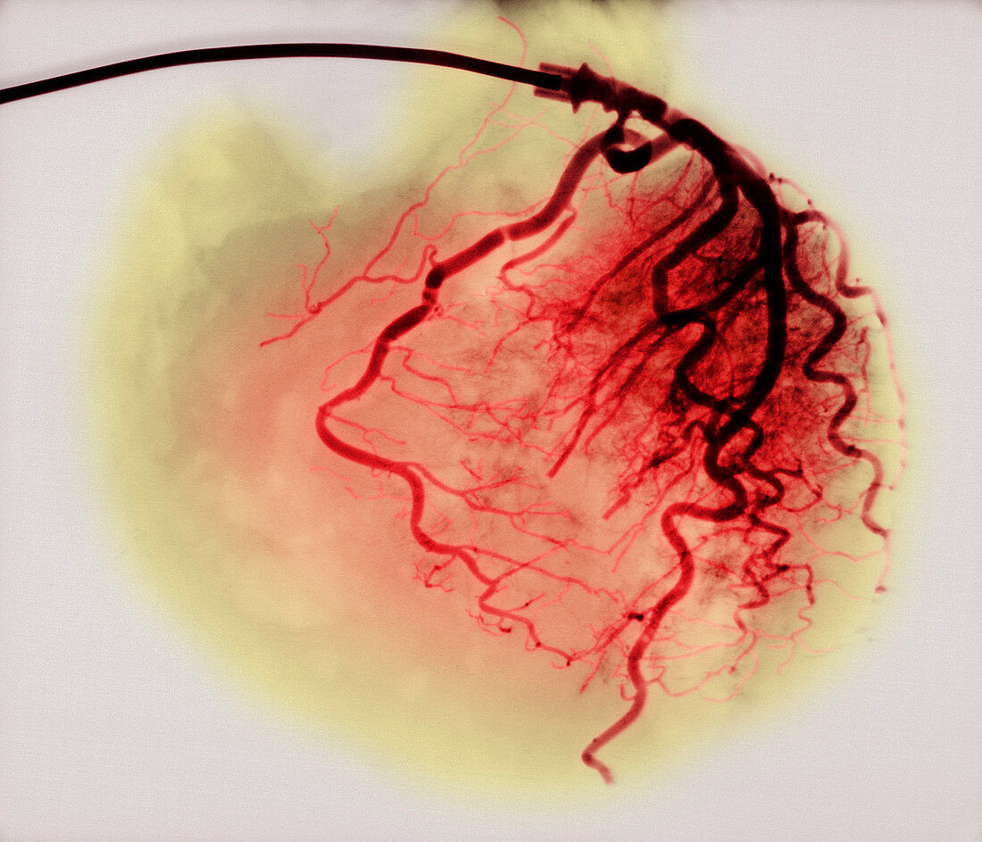 Donor heart angiogram