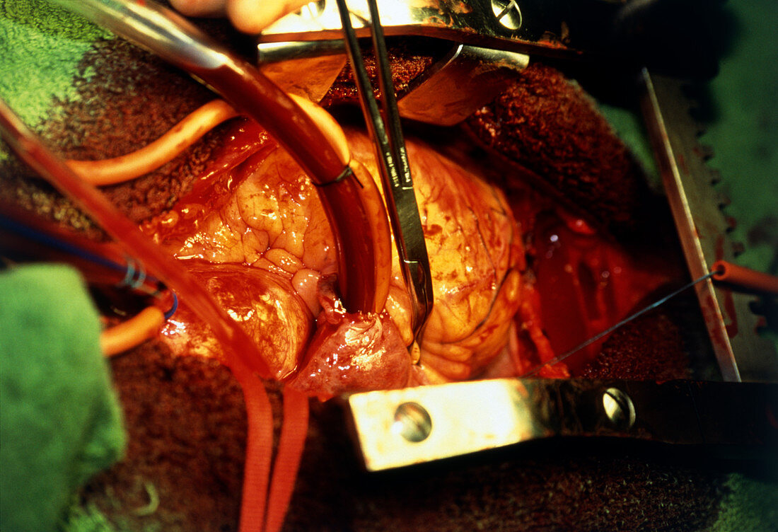 Heart surgery