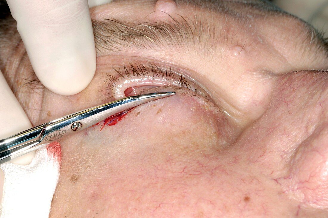 Eyelid surgery