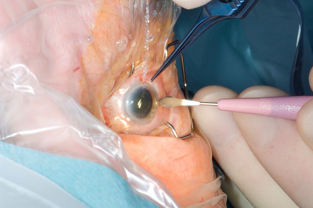 Cataract surgery