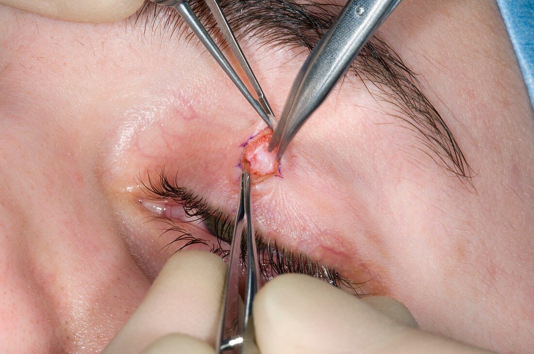 Eyelid surgery