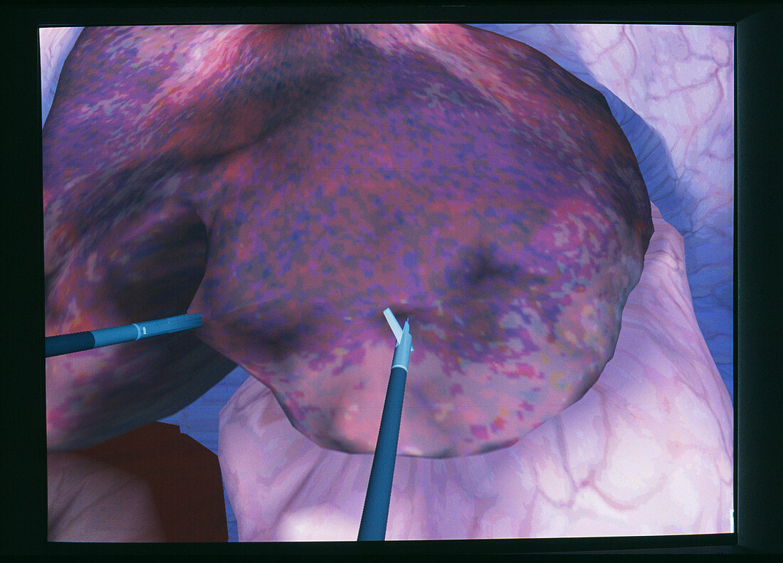 Virtual liver surgery