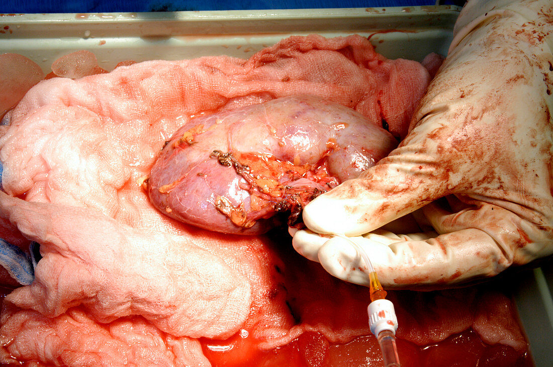 Kidney transplant