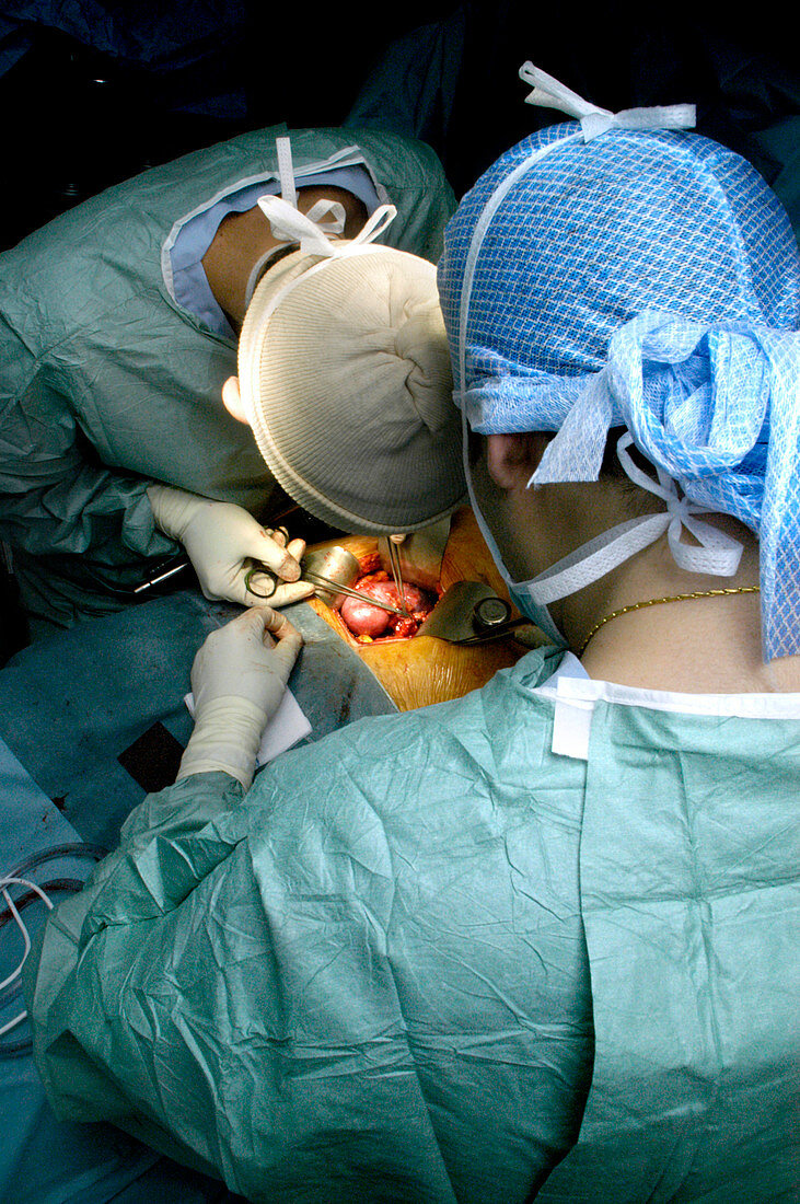 Kidney transplant