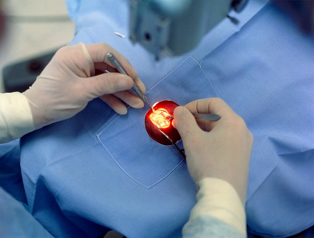 Microsurgery to remove cataract from eye