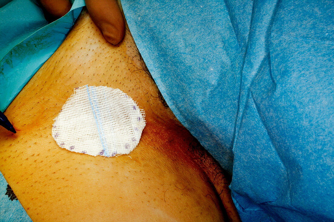 Nipple reconstruction surgery