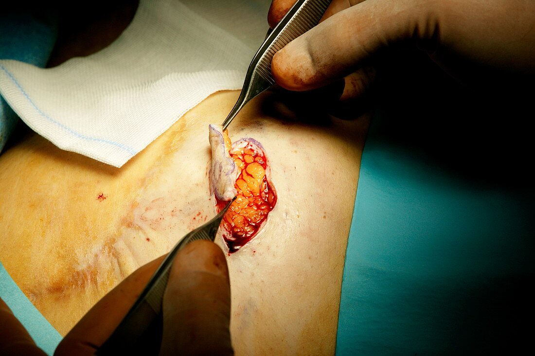 Nipple reconstruction surgery