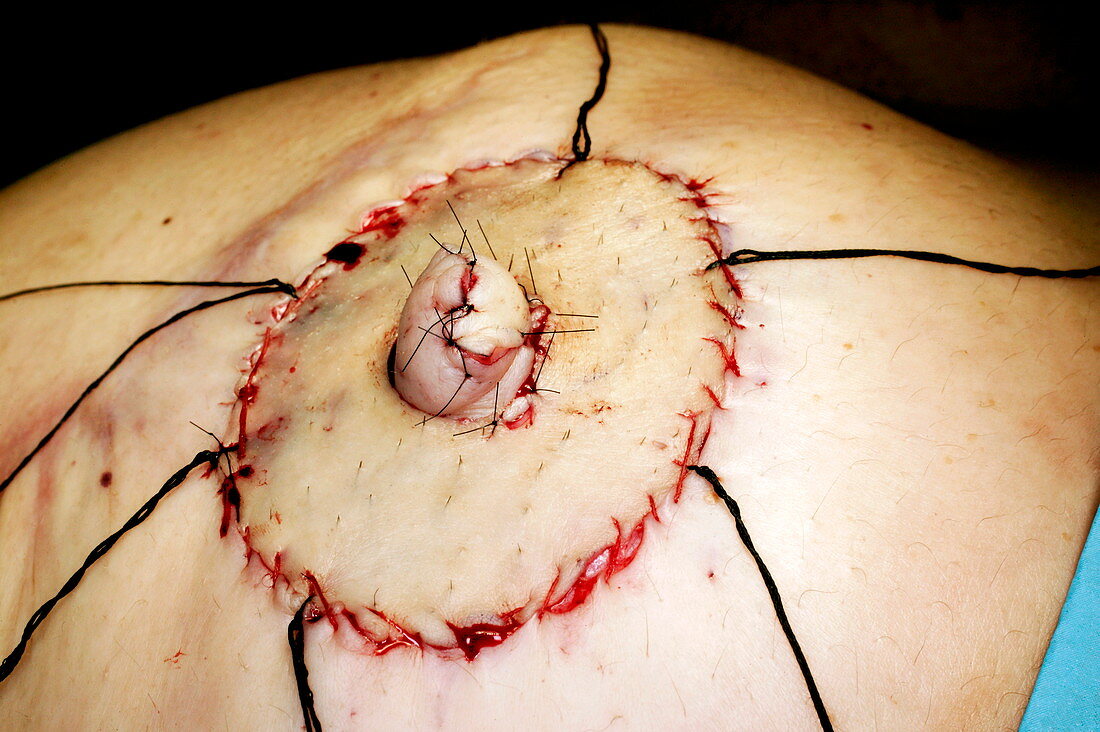 Nipple reconstruction surgery