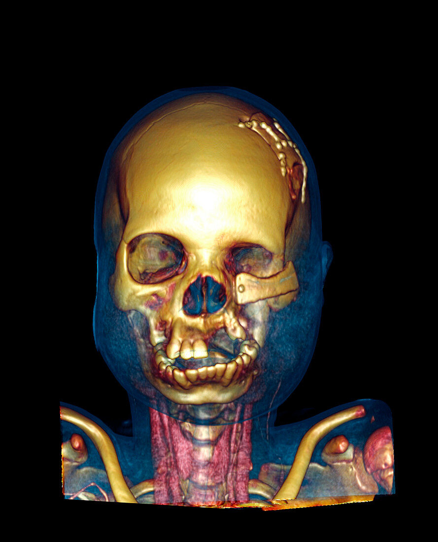 Facial reconstruction,CT scan