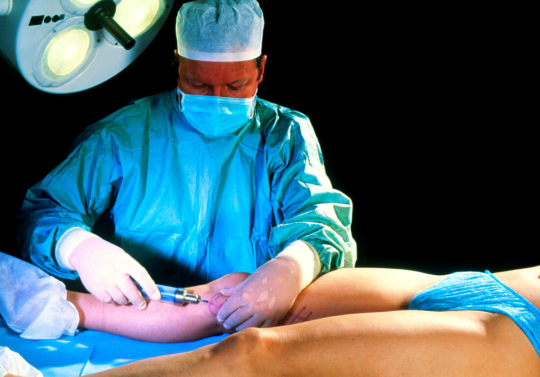 Surgeon conducting liposuction on patient's leg