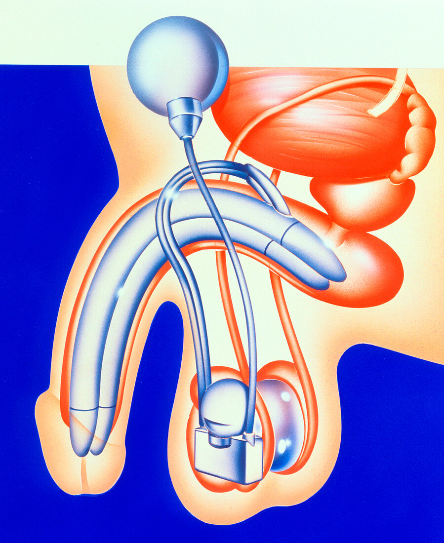 Artwork showing penis and testicle prostheses