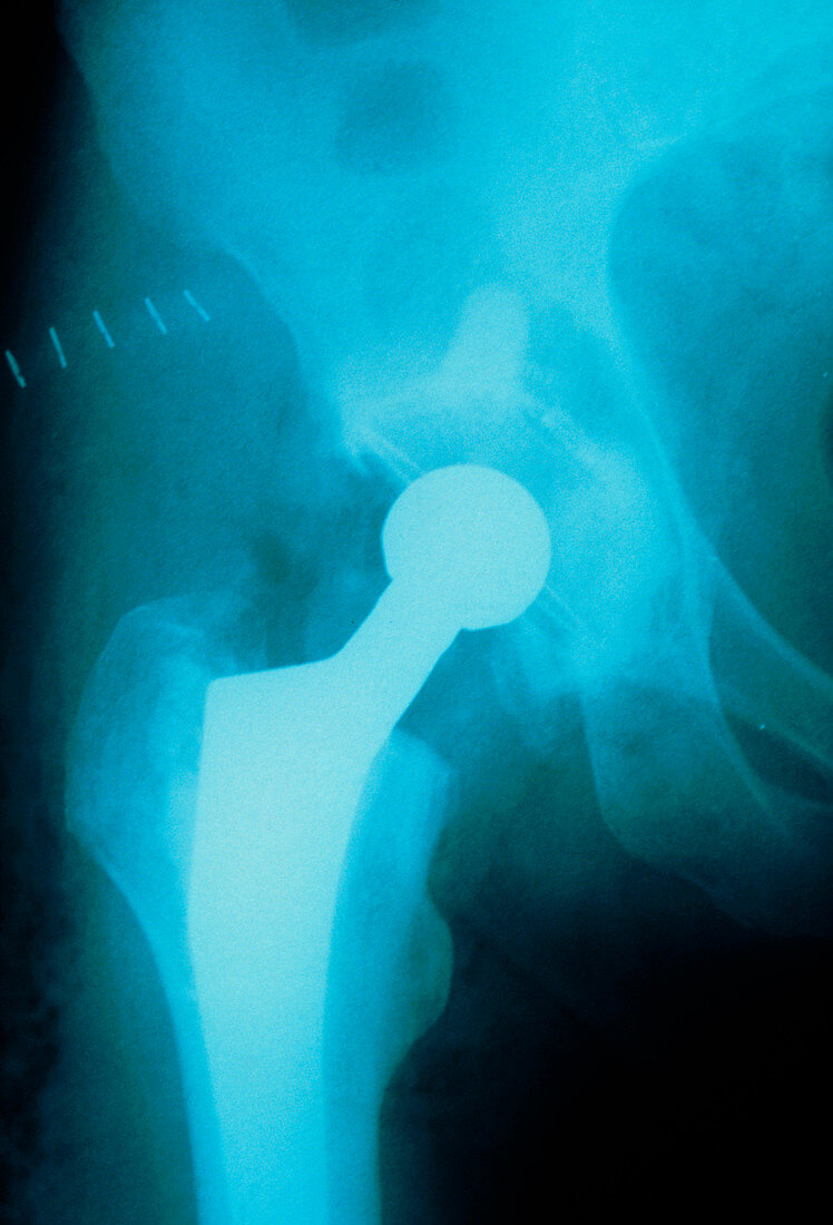 X-ray of artificial hip joint in elderly patient