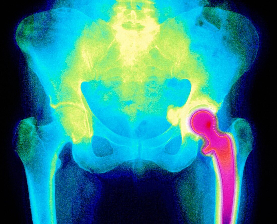 Coloured X-ray of an artificial hip joint