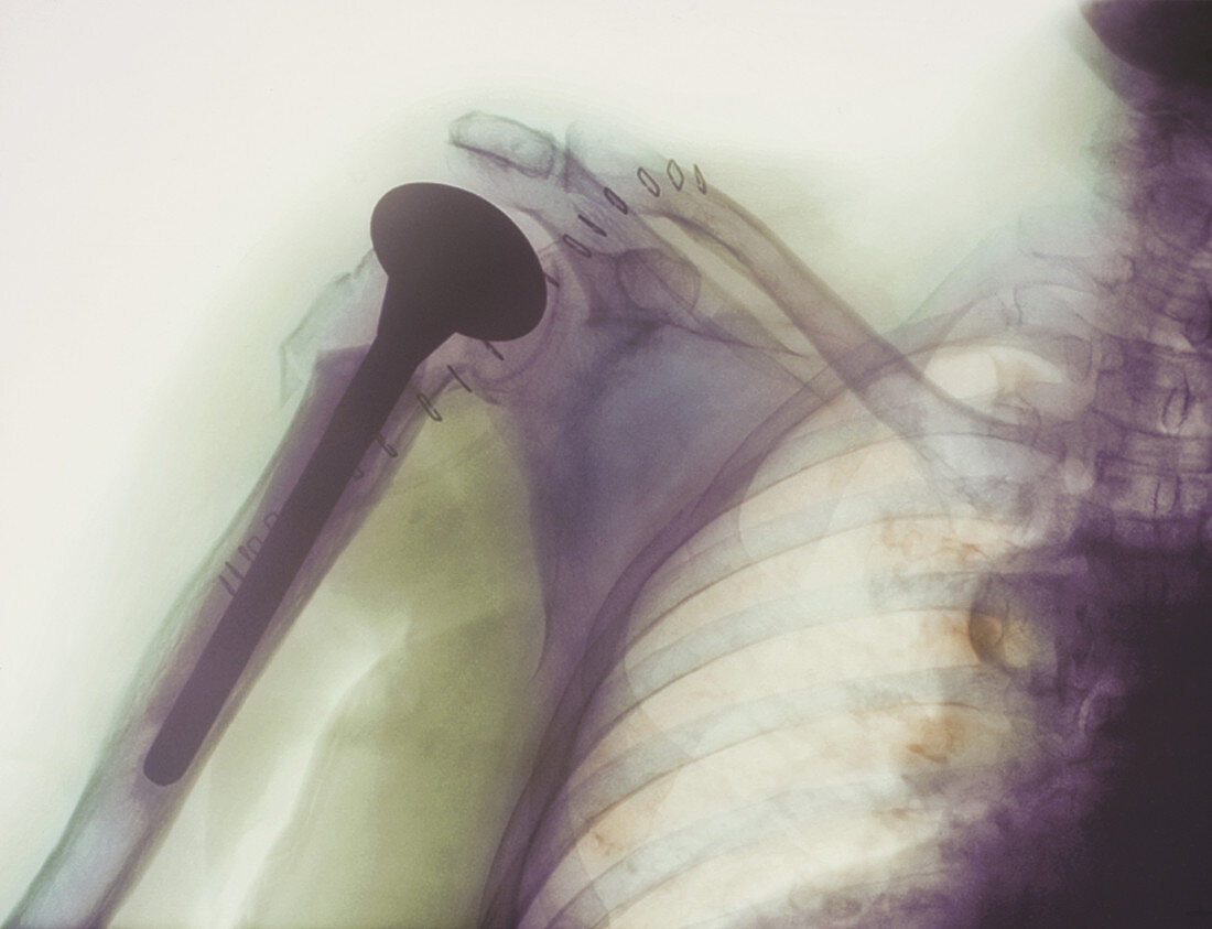 Shoulder prosthesis X-ray