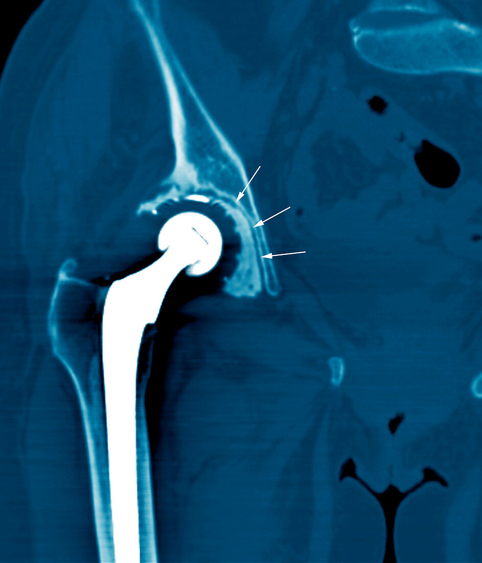 Loosened hip replacement,CT scan