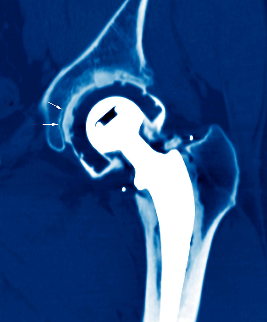 Loosened hip replacement,CT scan