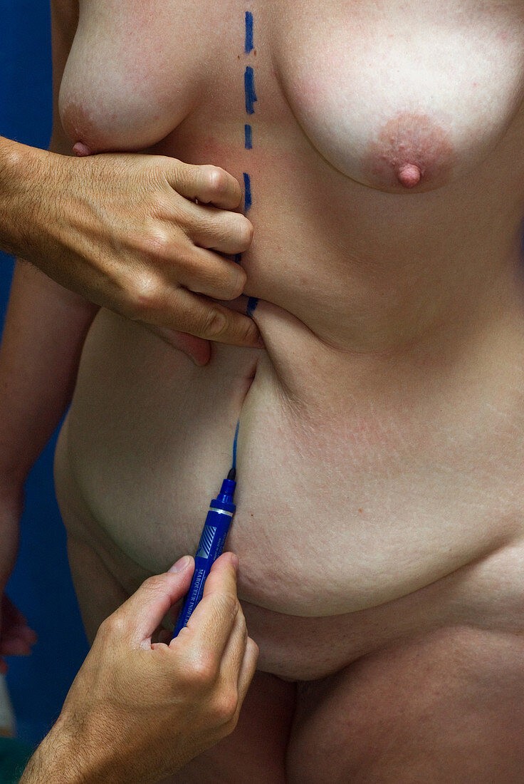 Cosmetic breast and abdominal surgery