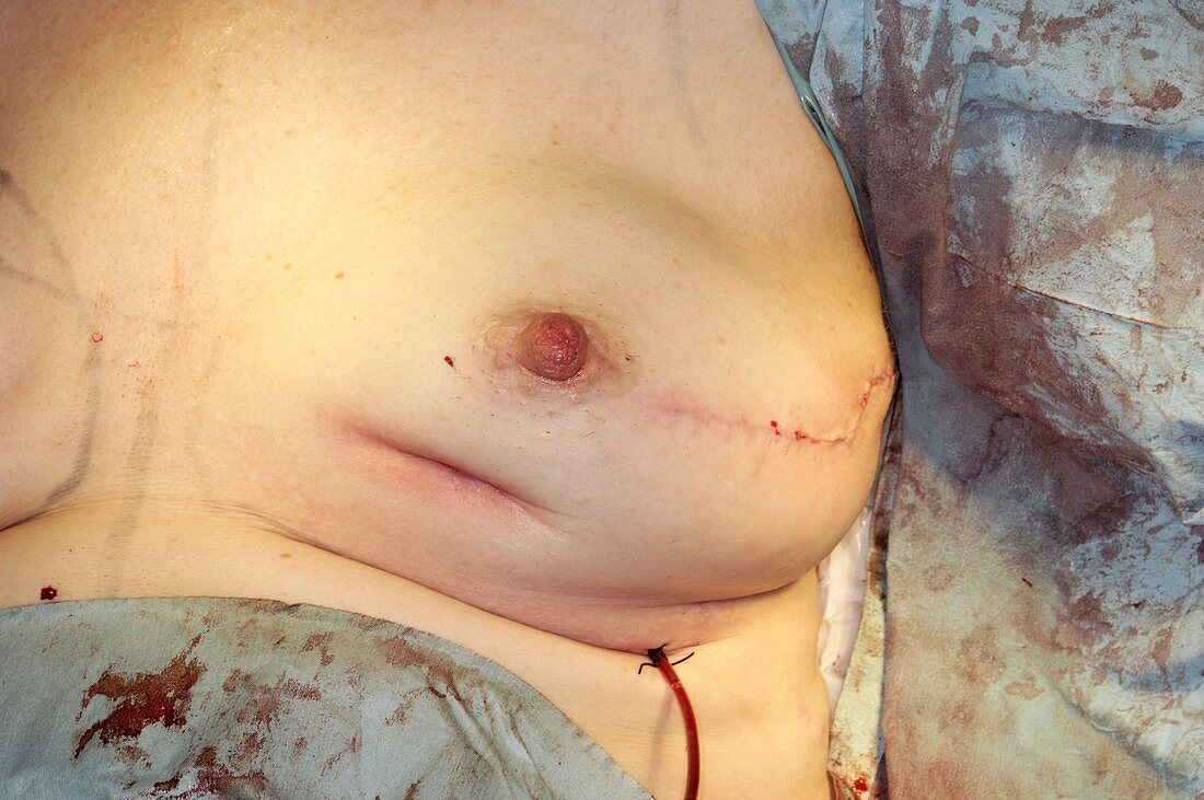 Breast implant surgery