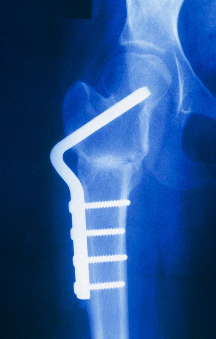 X-ray of femoral osteotomy for osteoarthritic hip