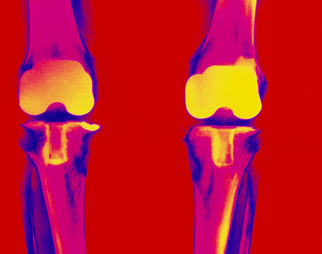 Coloured X-ray of prosthetic knee joints