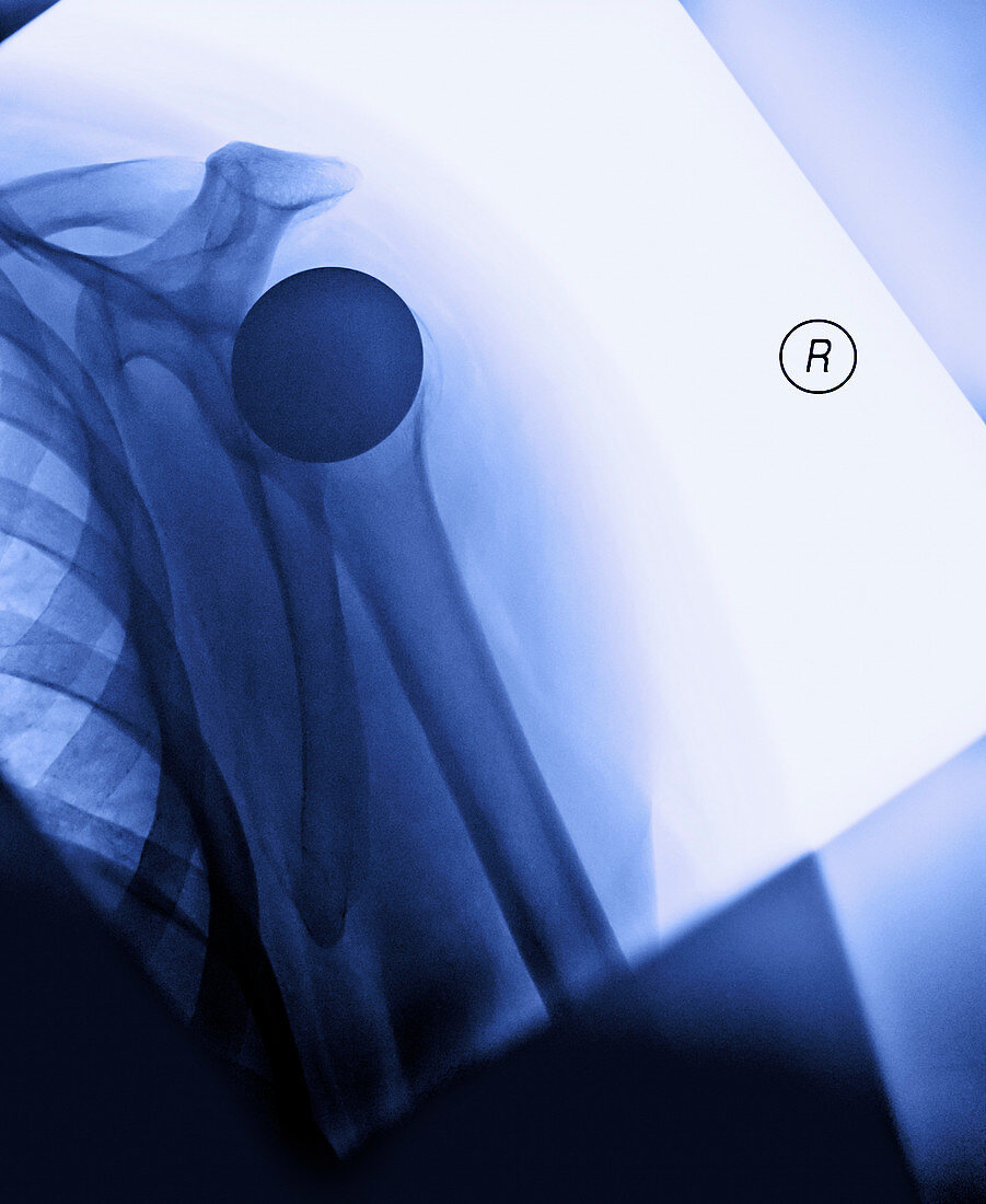 Artificial shoulder,X-ray