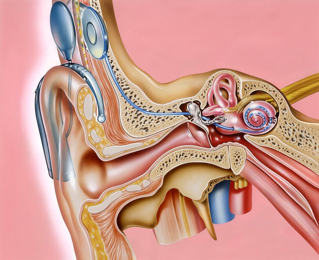 Cochlear implant,artwork