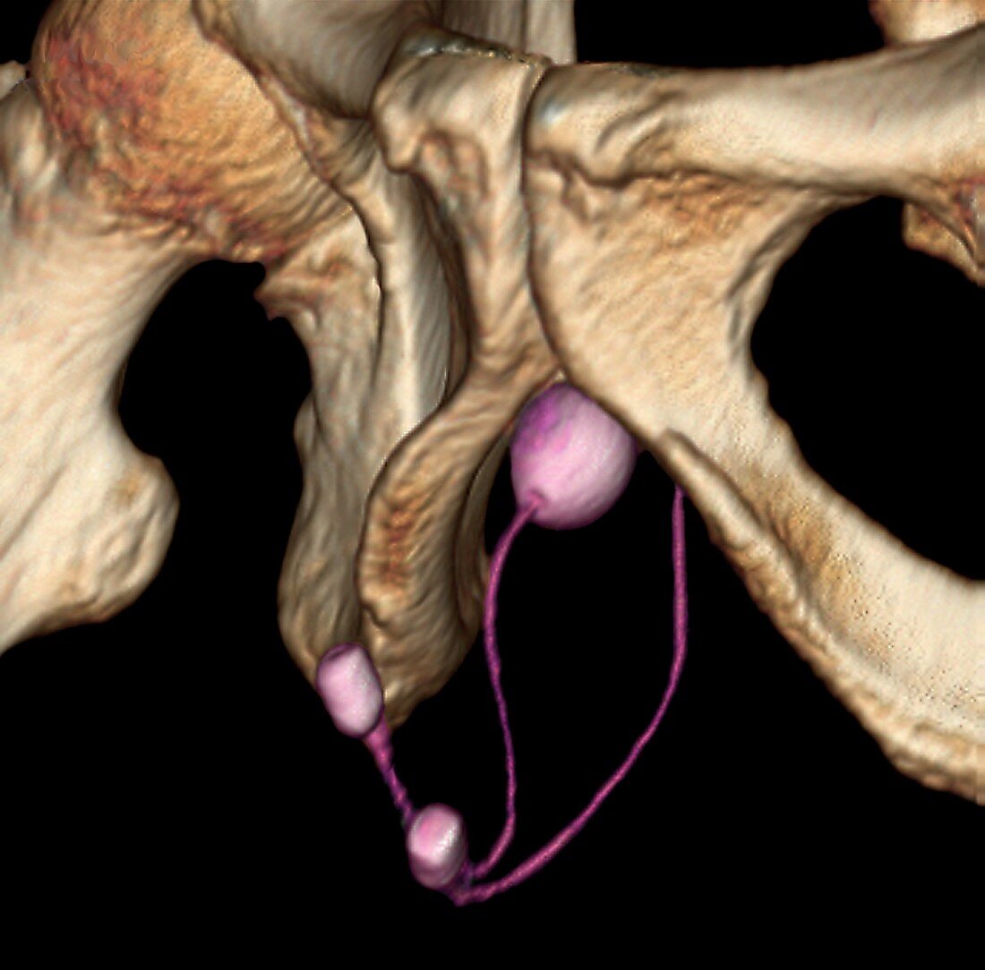 Artificial urinary sphincter,3D CT scan