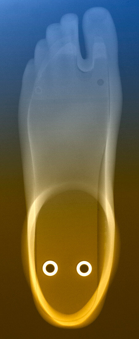 Prosthetic foot,X-ray