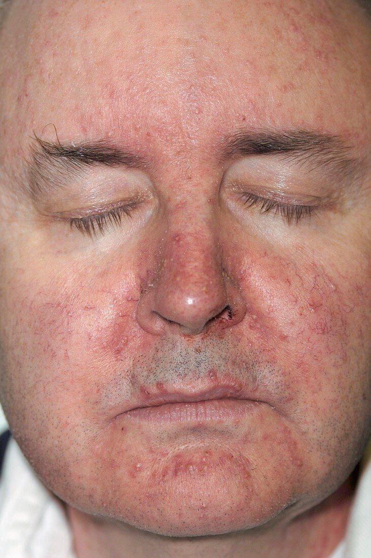 Skin rash following chemotherapy