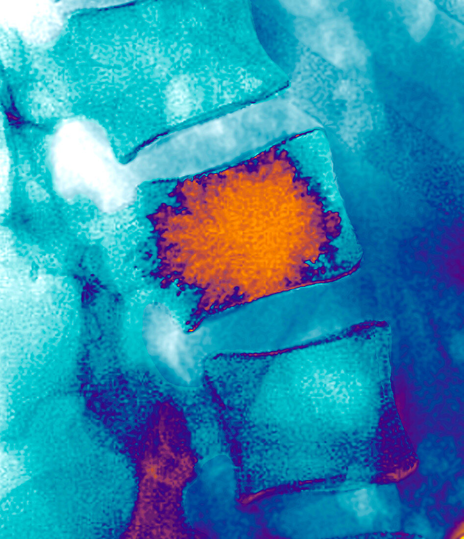 Spinal collapse treatment,X-ray