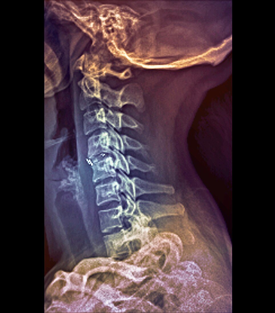Intervertebral bone graft,X-ray