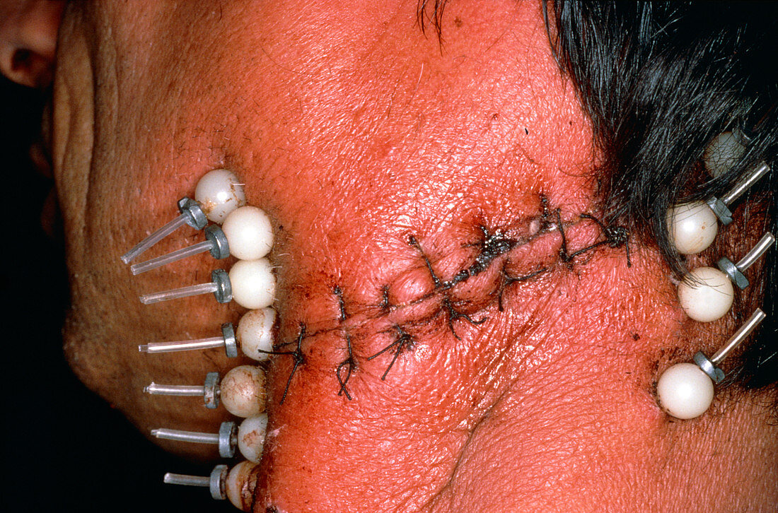 Radioactive iridium,wires implanted in man's neck