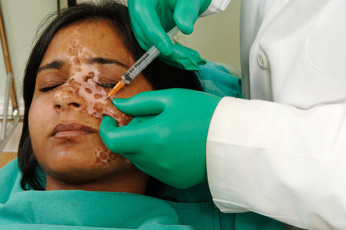 Vitiligo treatment,anaesthetic