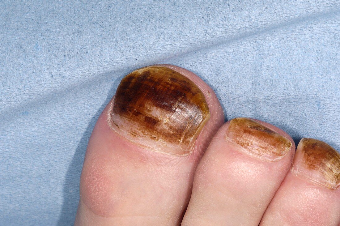 Stained toenails from ulcer treatment