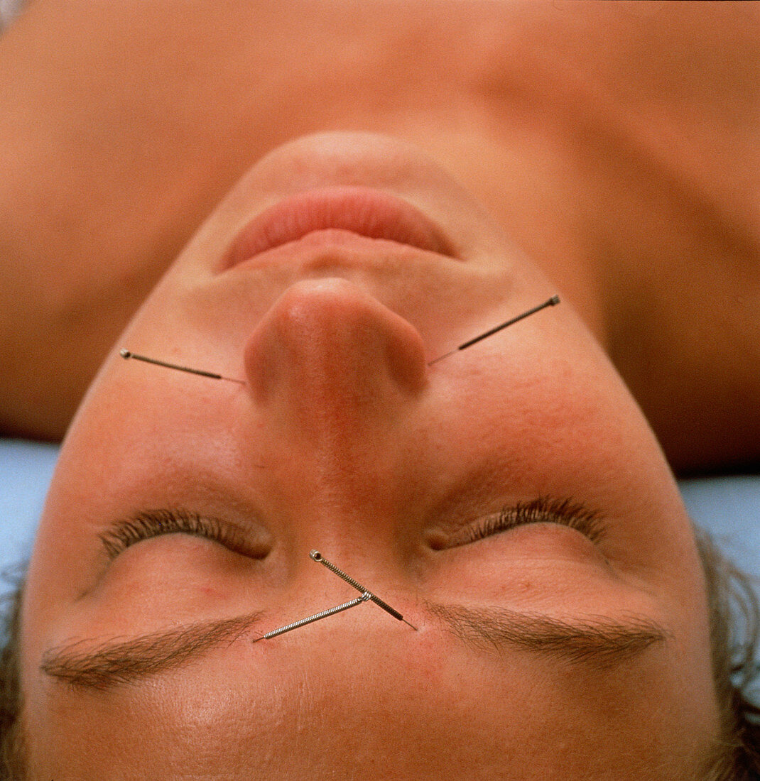 Patient undergoing acupuncture treatment