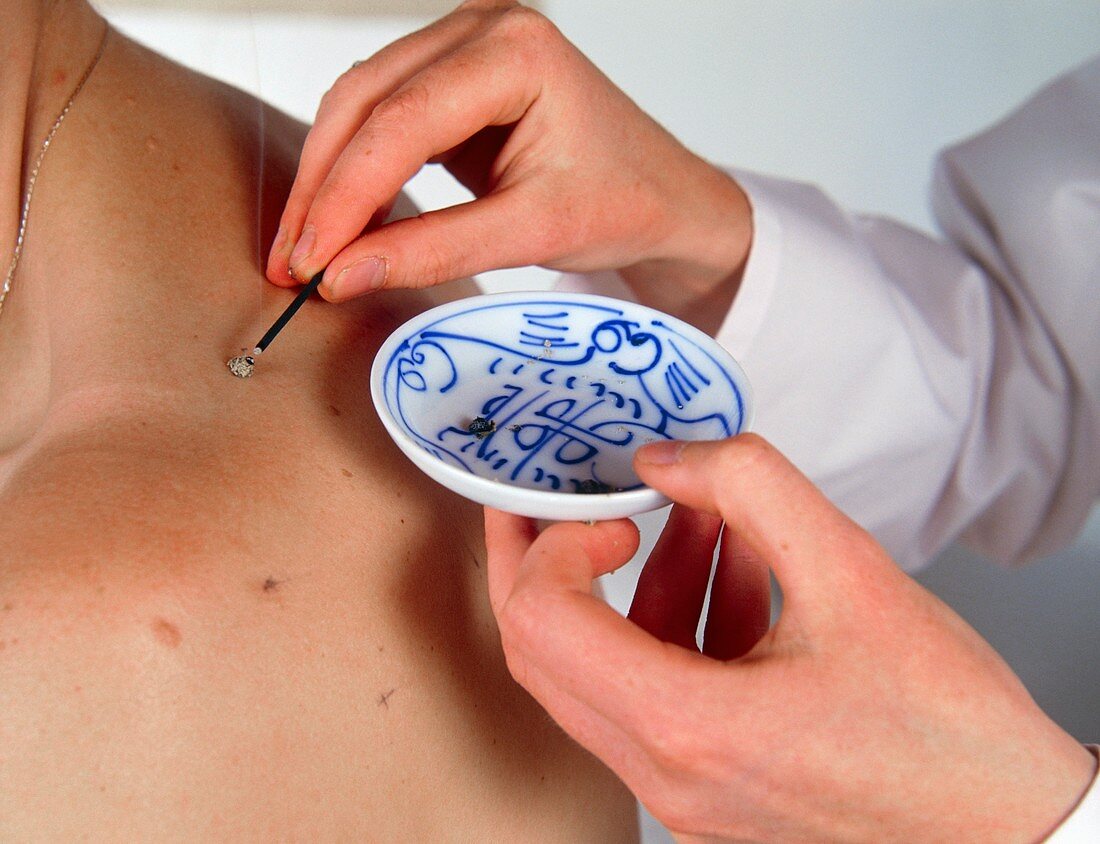 Patient undergoing a type of acupuncture