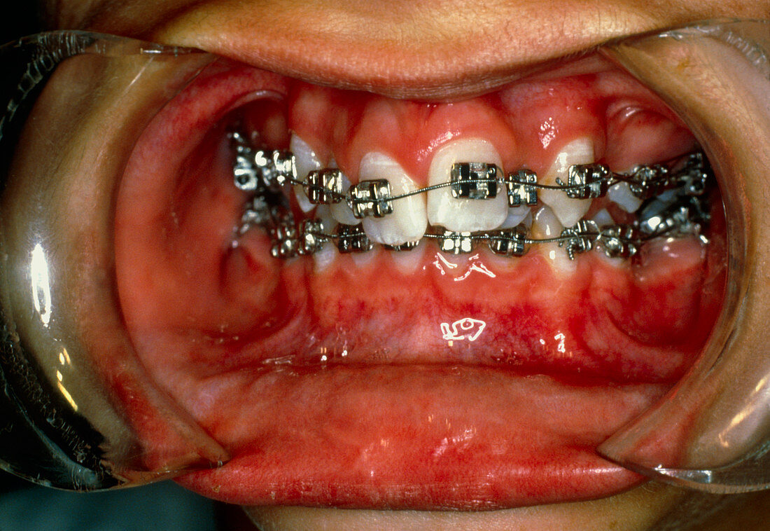 View of malaligned teeth being treated with braces